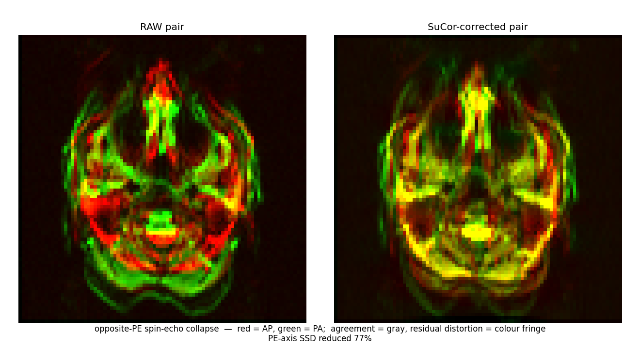 opposite-PE AP/PA spin-echo collapse after SuCor correction